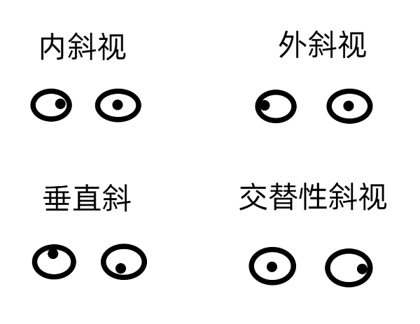 斜視早期的癥狀有哪些？